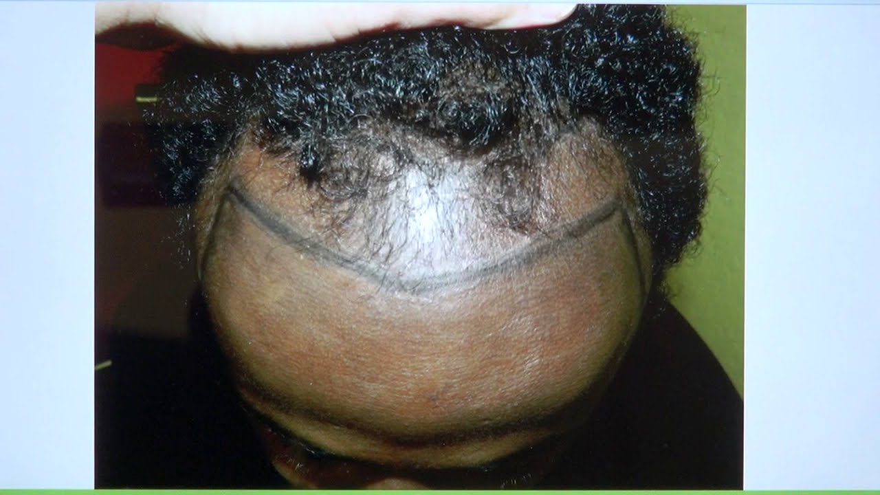 Black African Man Receding Hairline Hair Transplant Result 