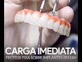 Carga Imediata - Prótese sobre implantes em até 24h