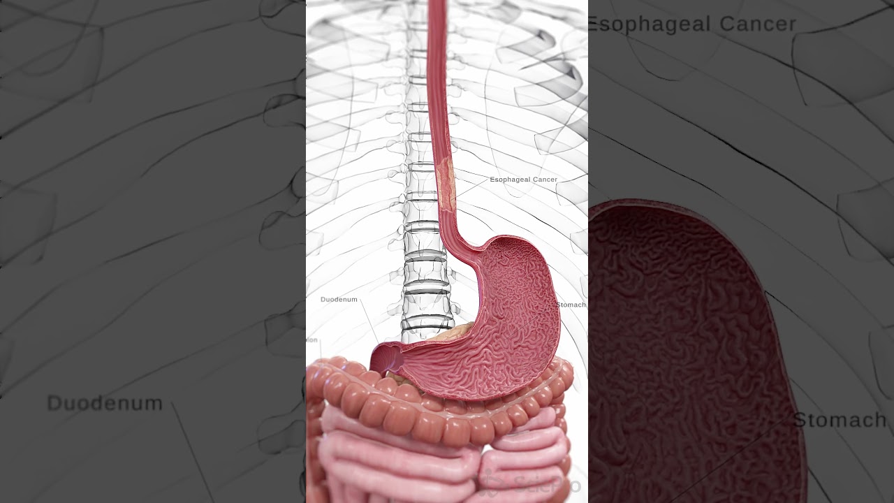 🔬 Understanding Esophageal Cancer: Early Detection Is Key 🔬 