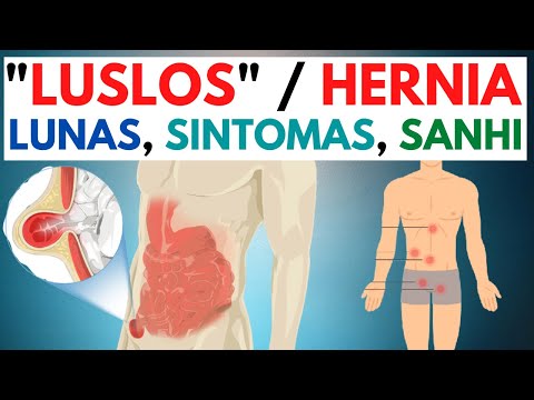 Video: 4 Mga Paraan upang Gamutin ang Paninigas ng Taas Pagkatapos ng Hernia Surgery