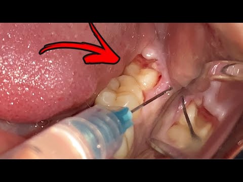 Geraham Bungsu | Geraham Ujung Bengkak | Dokter Gigi Tri Putra