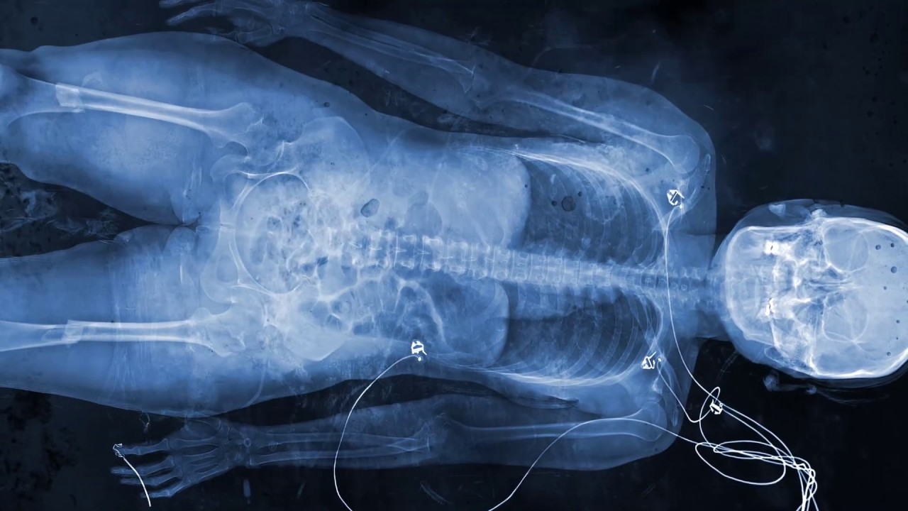 TRAILER "X rays _Radiography of the Melancholy" YouTube