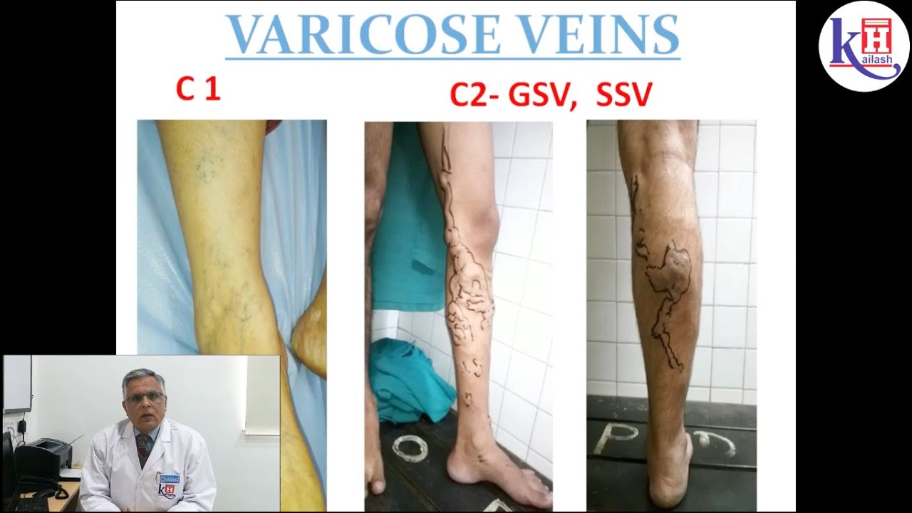 How to Treat Varicose Veins Without Surgery?