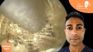 1,049 - Thick Infected Matted Ear Discharge & Ear Wax Removal