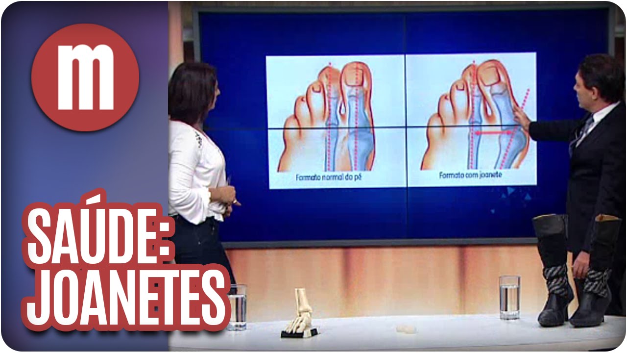 Mulheres - Saúde: Joanetes (22/03/16)