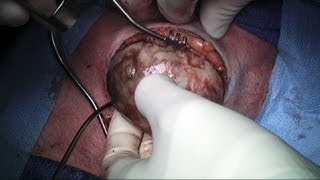 Thyroid Surgery \u0026 Its Risks / Complications (Thyroidectomy) (GRAPHIC)