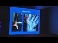 1st metacarpal base fracture dr  sudhir warrier