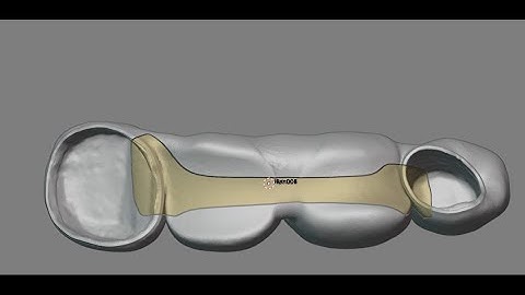 design an iBar on teeth in Blender4Dental