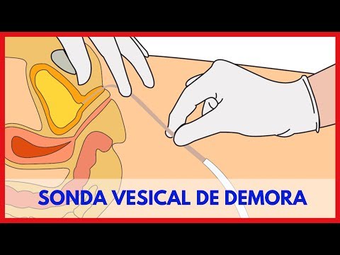 hqdefault - Cuidados com a Sonda Vesical de Demora