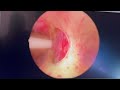 Il Rezūm trattamento mini-invasivo con vapore acqueo per la cura dell’ Ipertrofia prostatica benigna