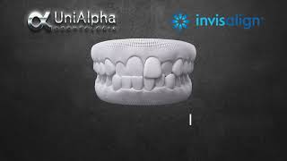 Invisalign - UniAlpha Odontologia