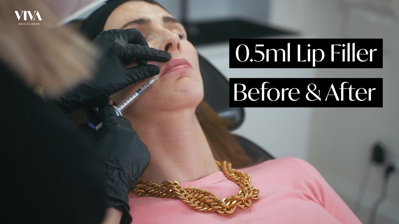 0.5ml Lip Filler Before & After | Natural Lip Filler Treatment | 2021
