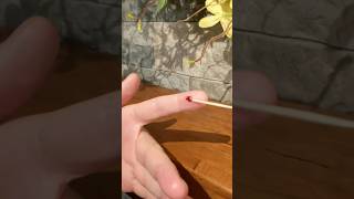 Huge Splinter In Finger