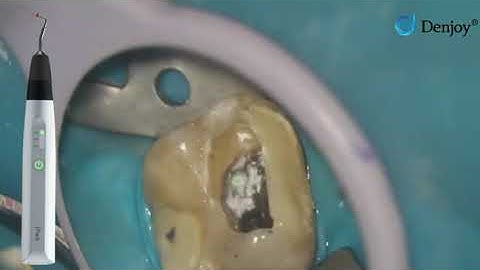 Denjoy new-brand single cordless gutta percha obturation pen