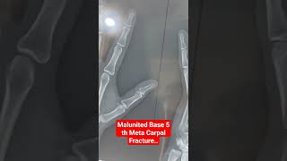 Malunited Base 5 th Meta Carpal Fracture..Dr Sai Chandra..Knee N Shoulder Surgeon in Hyderabad