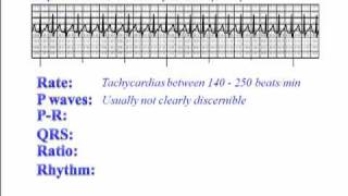 ECG: Supraventricular Tachycardia (SVT)