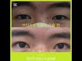 안검하수 수술 ptosis surgery #안검하수 #안검하수술 #ptosis #크리스성형외과 #chrisplasticsurgery