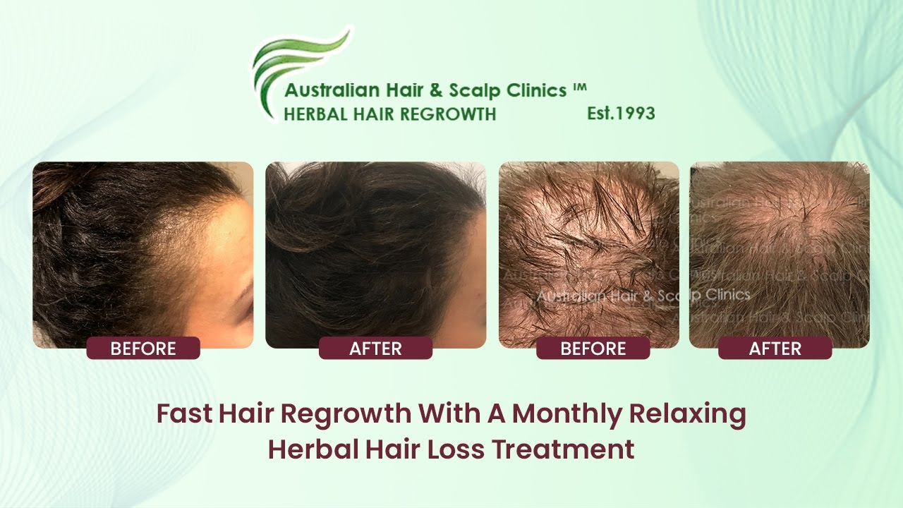 Fast Hair Regrowth With A Monthly Relaxing Herbal Hair Loss Treatment