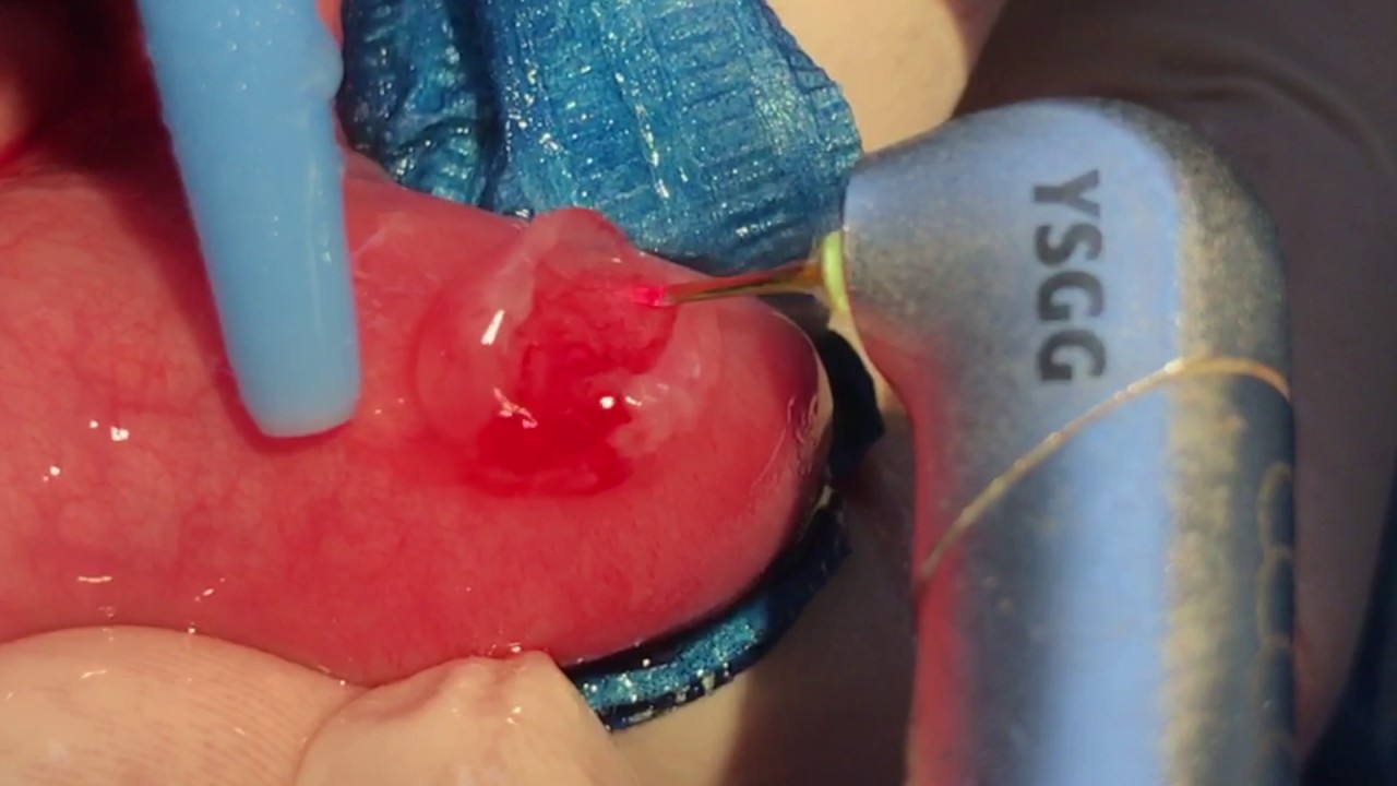 Mucocele labial tratamiento casero