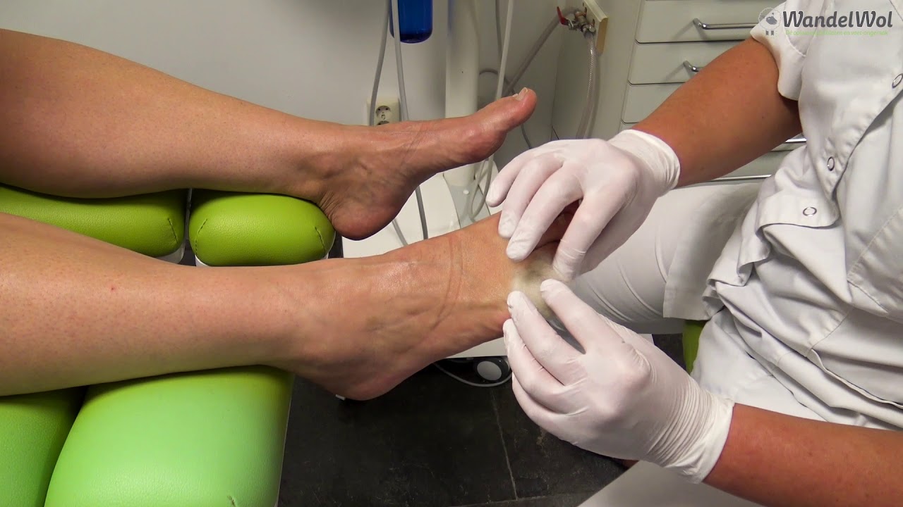 WandelWol - kleine teen likdoorn