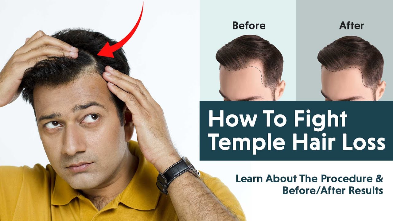 Does PRP Treatment Really Work For Temple Hair Loss YouTube