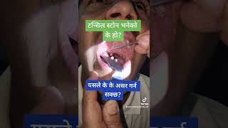 Tonsil Stones Tonsillolith Tonsillar Debris Removal Dr Krishna Koirala Pokhara