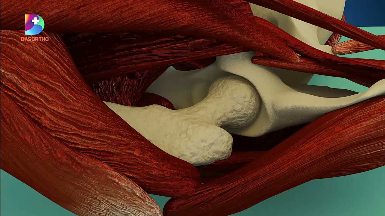 Hip Replacement Surgical Technique- PRATHMESH  Uncemented Hip System by  DKSORTHO
