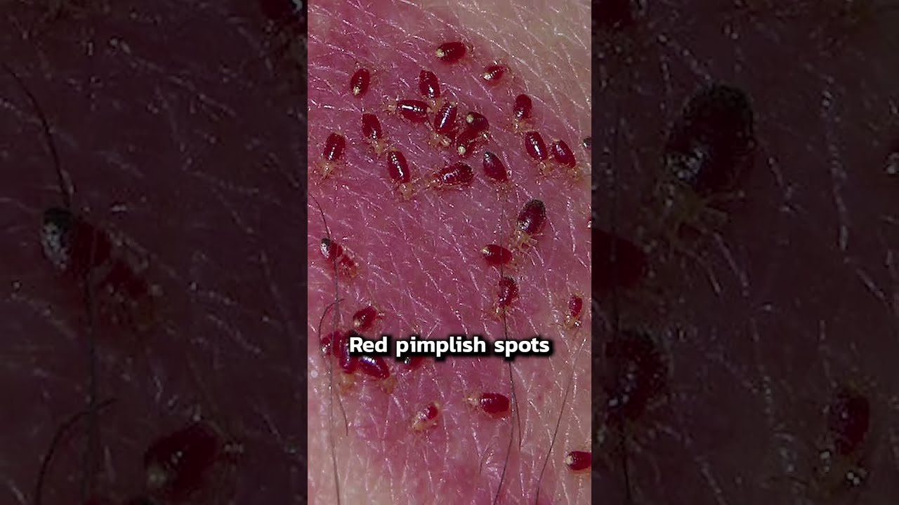 Signs Of Bedbugs Shorts