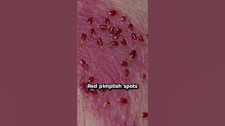 Signs of Bedbugs | #shorts