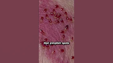 Signs Of Bedbugs Shorts 