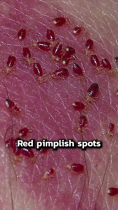 Signs of Bedbugs | #shorts