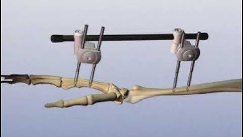 Distal Radius External Fixator for multifragmentary fractures
