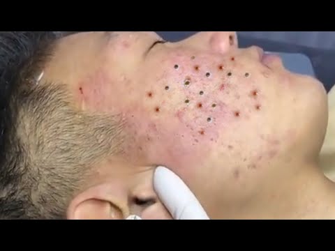 Loan Nguyen Acne Treatment 1701