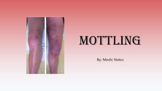 Skin mottling - definition, causes, pathophysiology, sign value