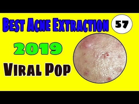Cystic Acne Treatment Jully  - New Video 