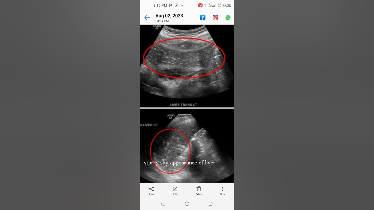 ultrasound-signs-starry-sky-appearance-of-liver-youtube