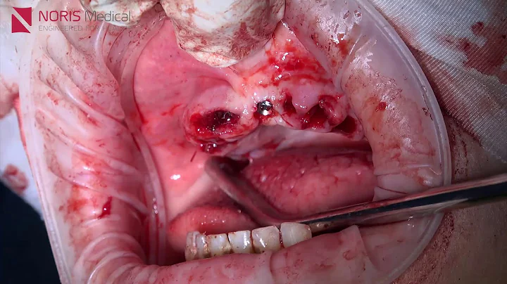 Immediate Implantation and Loading using Cortical ...