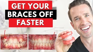 Orthodontist Explains The Secret to Getting Your Braces Off Faster | Dr. Nate