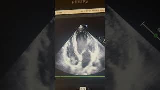 Intracardiac thrombus on tunneled central venous catheter tip in RA - Transthoracic Echocardiography