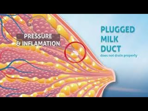 6 - Breastfeeding:  Plugged Milk Ducts