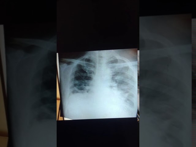 一次X片翻拍X-Ray Photos (第20200723第0009期)