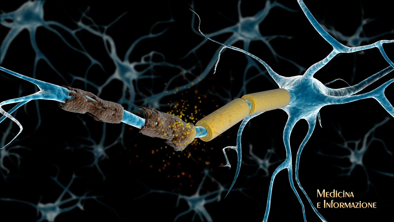GIIORNATA MONDIALE DELLA SCLEROSI MULTIPLA: I TRAGUARDI RAGGIUNTI DALLA RICERCA E LE SFIDE FUTURE
