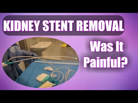 Kidney Stent Removal