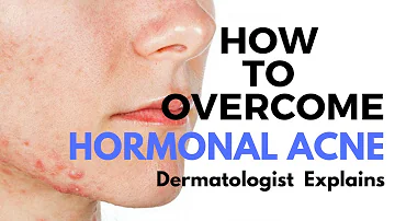 How do you stop androgens from acne?