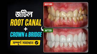 জটিল দাঁতের সমস্যা থেকে সম্পূর্ণ সমাধান | Crown, Bridge & Implant RehabilitationOption 2