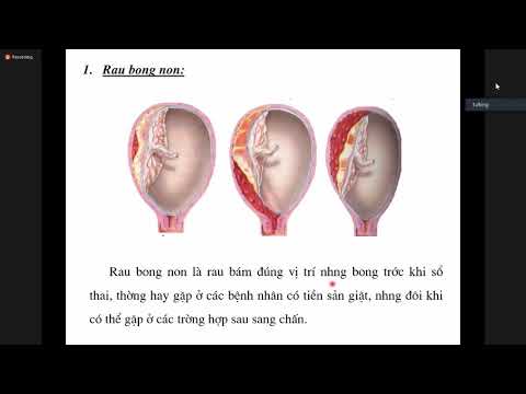 Video: Tại Sao Chỉ định Mổ Lấy Thai?