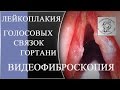 №28 Лейкоплакія голосових складок гортані- відеофіброскопія, пацієнт №16