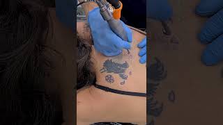 Removendo O Dragão Super Pigmentado Das Costas Remoção De Tatuagem