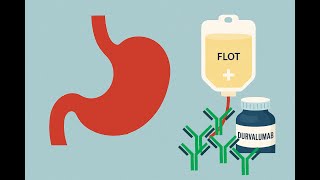 Erken Evre Mide Kanserinde Durvalumab + Flot Ile İlk Kez Genel Sağkalım Farkı Resimi