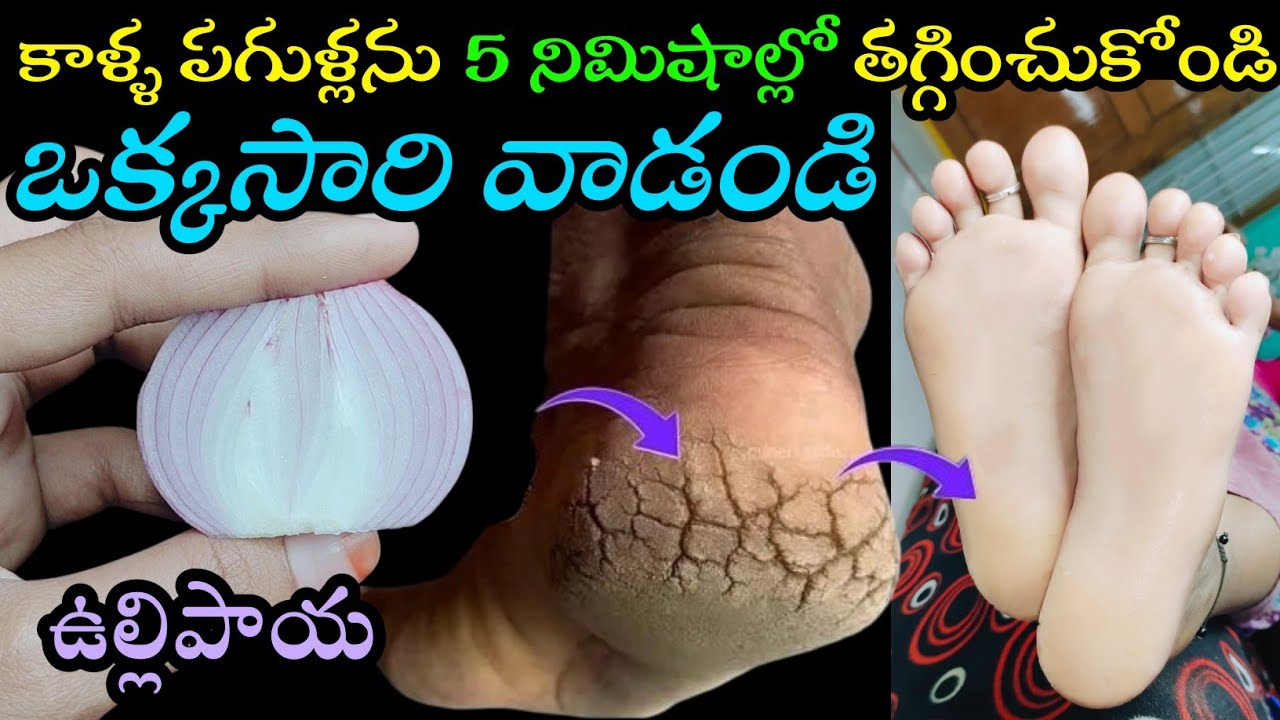 🧅ఉల్లిపాయతో 5 నిమిషాల్లో కాళ్ల పగులను ఒక్కసారికే తొలగించుకోండి👍Remove crack heels permanently 5 mins